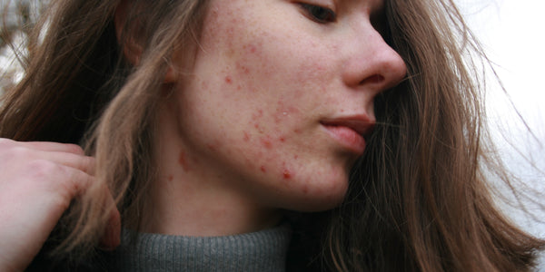 Does Nicotine Cause Acne? A Detailed Overview of How Nicotine Affects Your Skin